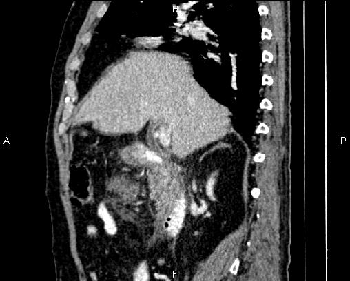 Acute pancreatitis (Radiopaedia 85146-100701 Sagittal C+ portal venous phase 33).jpg