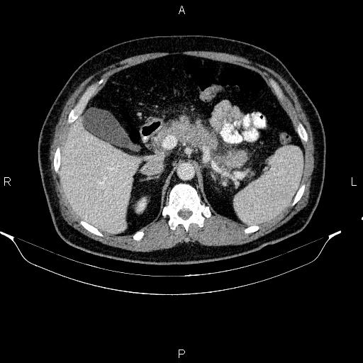 File:Acute pancreatitis (Radiopaedia 85390-101010 Axial C+ portal venous phase 32).jpg