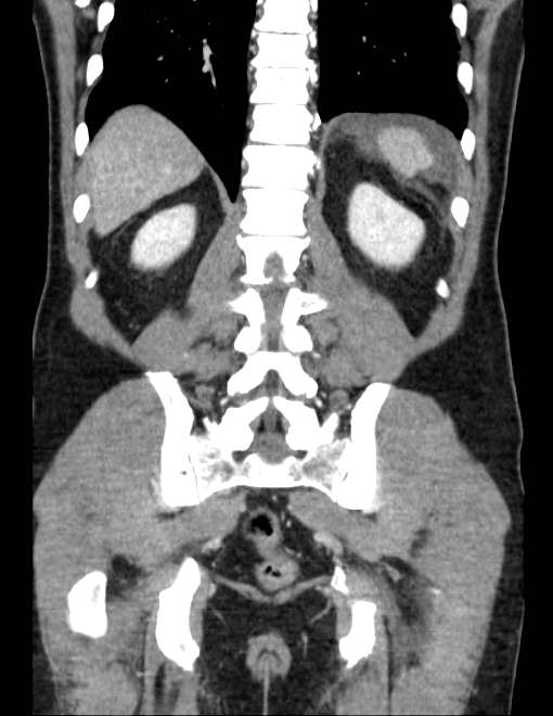 Acute pancreatitis - Balthazar E (Radiopaedia 23080-23110 Coronal C+ portal venous phase 62).jpg