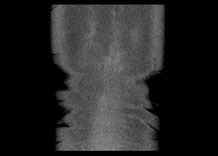 Acute pancreatitis and walled-off necrosis (Radiopaedia 29888-30403 Coronal C+ portal venous phase 55).jpg