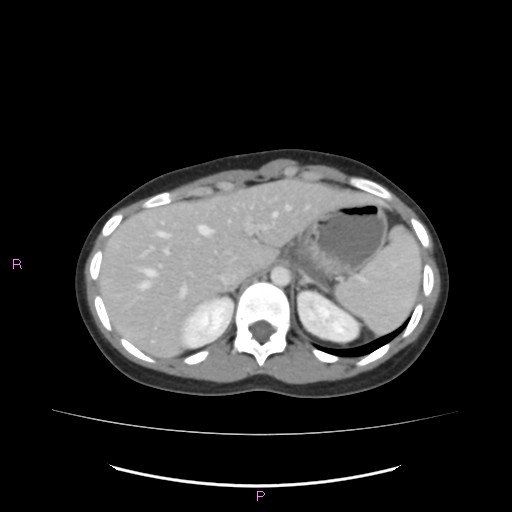 Acute pancreatitis secondary to stone at minor papilla and pancreatic divisum (Radiopaedia 76570-88333 Axial C+ portal venous phase 17).jpg