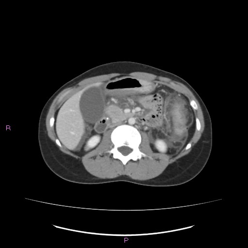 Acute pancreatitis secondary to stone at minor papilla and pancreatic divisum (Radiopaedia 76570-88333 Axial C+ portal venous phase 34).jpg
