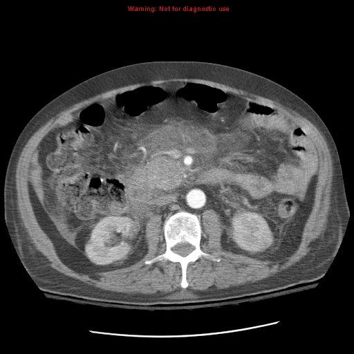 Acute pancreatitis with incidental pancreatic lipoma (Radiopaedia 10190-10730 Axial C+ arterial phase 49).jpg