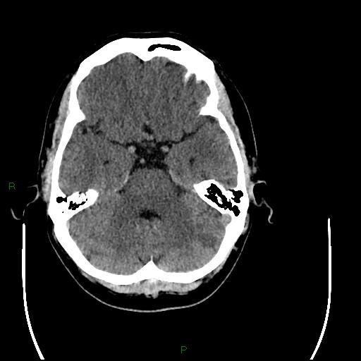 File:Acute posterior cerebral artery territory infarct (Radiopaedia 79329-92393 Axial non-contrast 32).jpg
