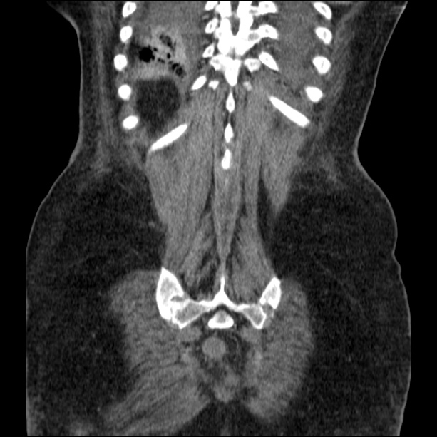 Acute pyelonephritis (Radiopaedia 26584-26729 C+ portal venous phase 64).jpg