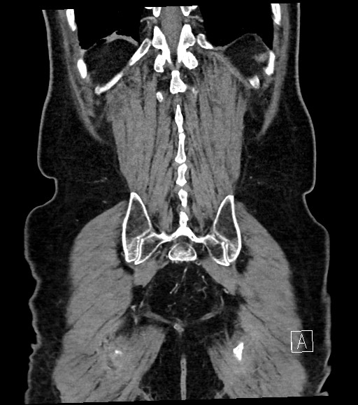 Acute renal infarction (Radiopaedia 59375-66736 Coronal C+ portal venous phase 54).jpg
