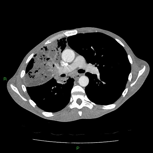File:Acute right lung abscess (Radiopaedia 34806-36258 Axial C+ arterial phase 81).jpg