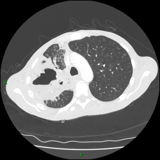 Acute right lung abscess (Radiopaedia 34806-36258 Axial lung window 58).jpg