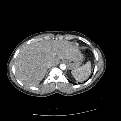 File:Acute segmental pulmonary emboli and pulmonary infarction (Radiopaedia 62264-70444 Axial C+ CTPA 102).jpg