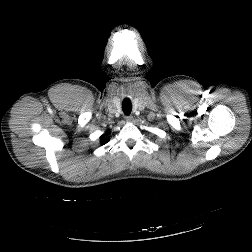 File:Acute segmental pulmonary emboli and pulmonary infarction (Radiopaedia 62264-70444 Axial C+ CTPA 9).jpg