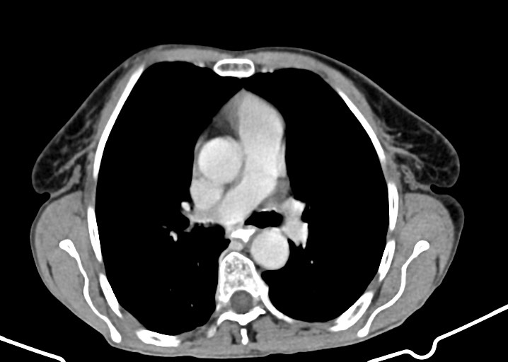 Acute small bowel (ileal) volvulus (Radiopaedia 71740-82139 Axial C+ portal venous phase 6).jpg