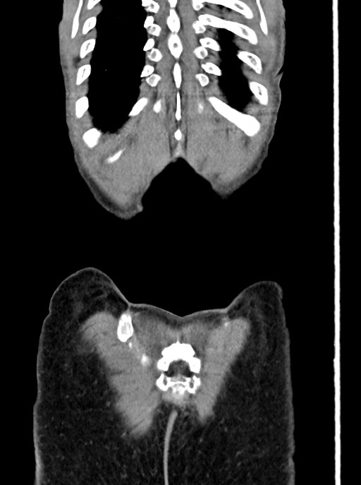 Acute small bowel (ileal) volvulus (Radiopaedia 71740-82139 Coronal C+ portal venous phase 105).jpg