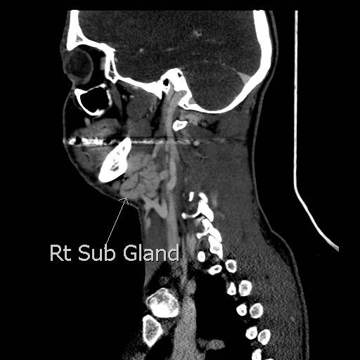 File:Acute submandibular sialadenitis secondary to ductal stone (Radiopaedia 27999-28267 Sagittal C+ delayed 13).jpg