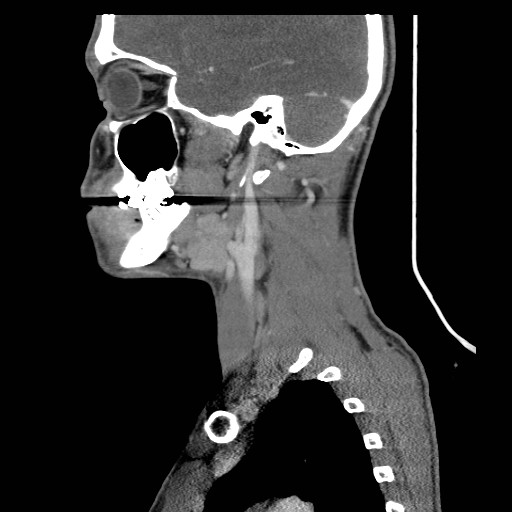 File:Acute submandibular sialadenitis secondary to ductal stone (Radiopaedia 27999-28267 Sagittal C+ delayed 33).jpg