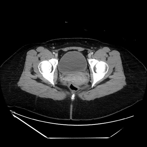 File:Acute uncomplicated appendicitis (Radiopaedia 73704-84499 Axial C+ portal venous phase 154).jpg