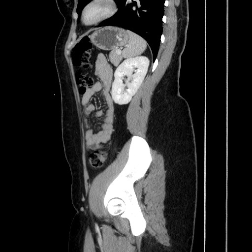 Acute uncomplicated appendicitis (Radiopaedia 73704-84499 Sagittal C+ portal venous phase 146).jpg