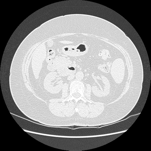 Adenocarcinoma in situ of lung (Radiopaedia 38685-40829 B 260).png