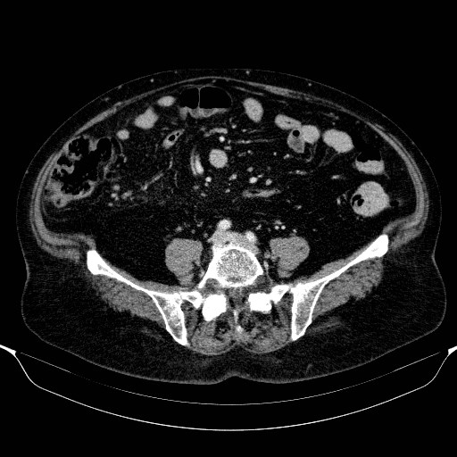 File:Adenocarcinoma of the appendix (Radiopaedia 31023).jpg