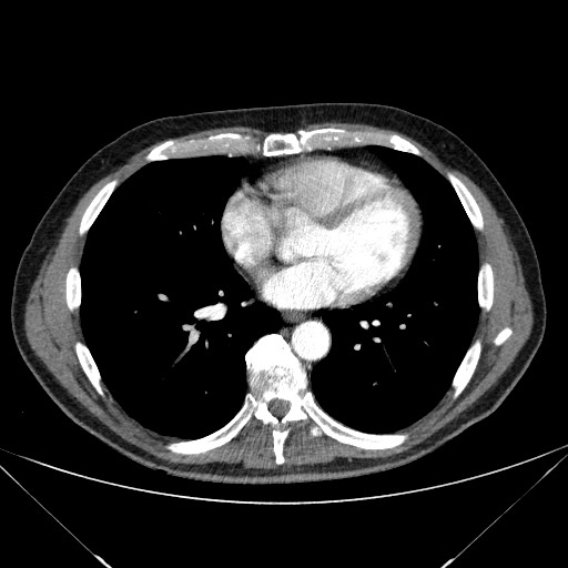 Adenocarcinoma of the lung (Radiopaedia 59871-67325 Axial C+ arterial phase 59).jpg