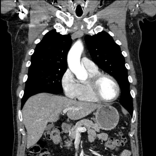 Adenocarcinoma of the lung (Radiopaedia 59871-67325 Coronal C+ arterial phase 21).jpg