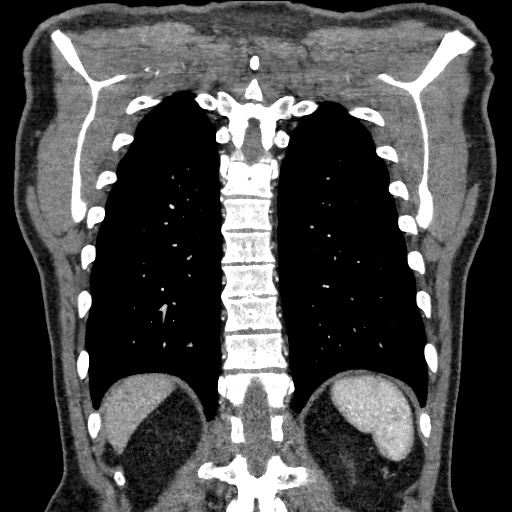 Adenocarcinoma of the lung (Radiopaedia 59871-67325 Coronal C+ arterial phase 58).jpg