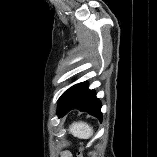 Adenocarcinoma of the lung (Radiopaedia 59871-67325 Sagittal C+ arterial phase 96).jpg