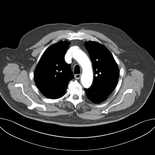 Adenocarcioma of rectum- T1 lesion (Radiopaedia 36921-38547 Axial C+ arterial phase 19).png