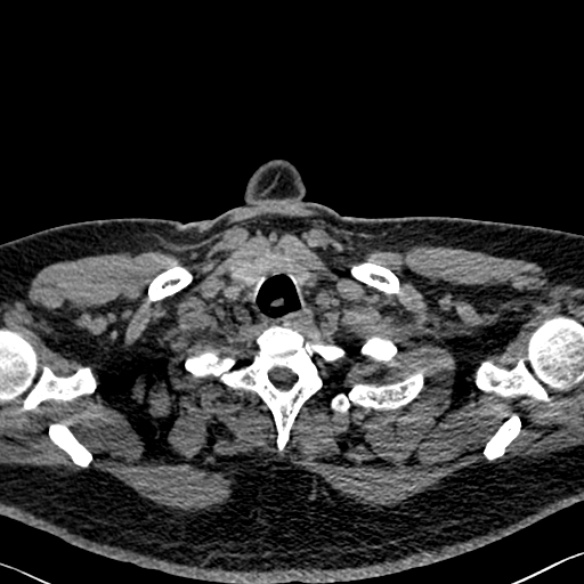 File:Adenoid cystic carcinoma of the trachea (Radiopaedia 49042-54137 Axial non-contrast 13).jpg