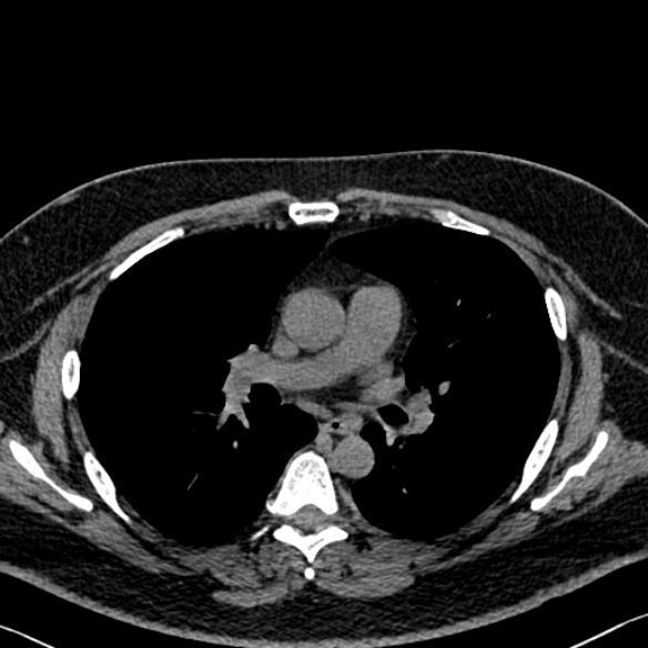 Adenoid cystic carcinoma of the trachea (Radiopaedia 49042-54137 Axial non-contrast 165).jpg