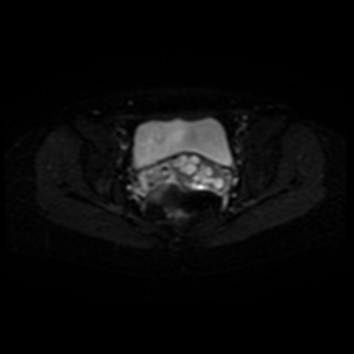 Adenoma malignum of cervix (Radiopaedia 66441-75705 Axial DWI 13).jpg