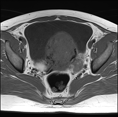 File:Adenomyosis - ovarian endometriomas (Radiopaedia 67031-76350 Axial T1 16).jpg