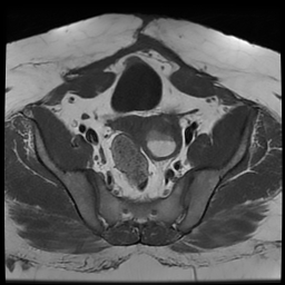 File:Adenomyosis within a didelphys uterus (Radiopaedia 70175-80215 Axial T1 22).jpg