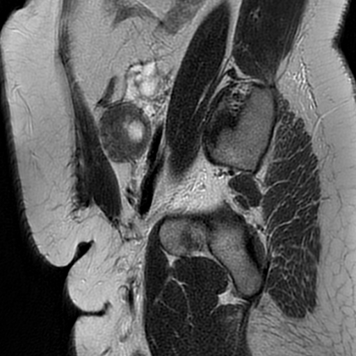 File:Adenomyosis within a didelphys uterus (Radiopaedia 70175-80215 Sagittal T2 32).jpg