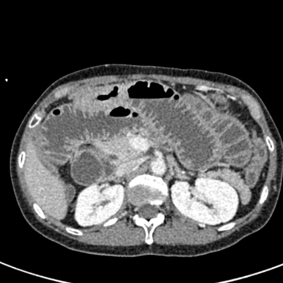 File:Adhesional small bowel obstruction (Radiopaedia 48397-53305 Axial C+ portal venous phase 23).jpg