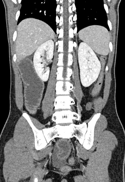 Adhesional small bowel obstruction (Radiopaedia 52107-57980 Coronal C+ portal venous phase 59).jpg
