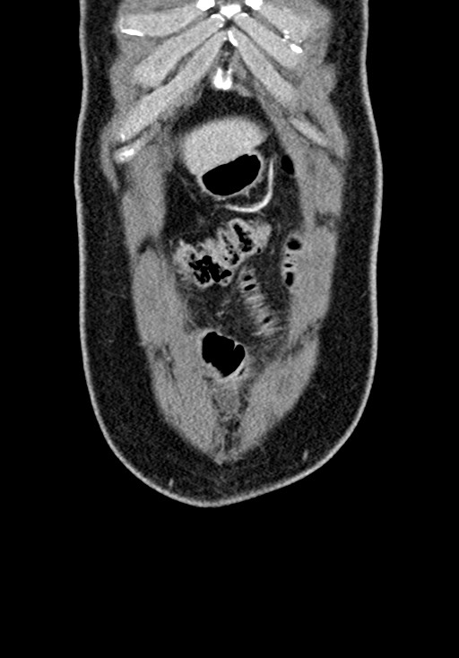 Adhesional small bowel obstruction (Radiopaedia 58900-66131 Coronal C+ portal venous phase 64).jpg