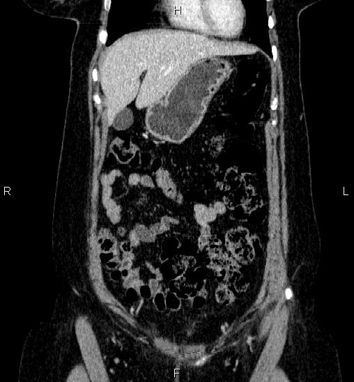 Adrenal cortical carcinoma (Radiopaedia 84882-100379 Coronal C+ portal venous phase 14).jpg