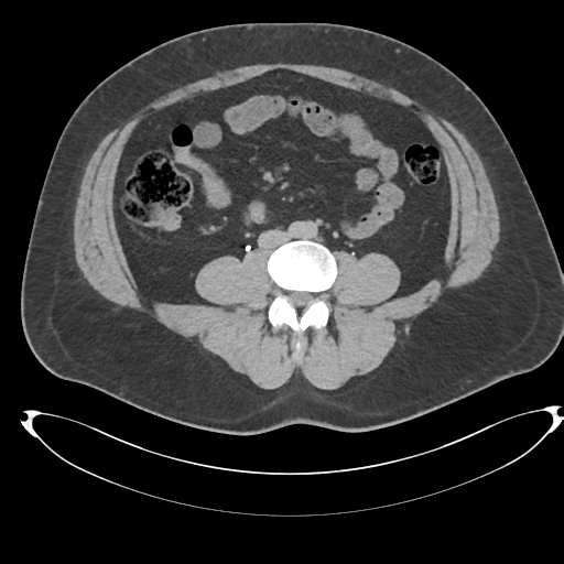 Adrenal cyst (Radiopaedia 45625-49778 AXIAL THICK 15 min 65).png
