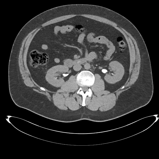 Adrenal cyst (Radiopaedia 45625-49778 Axial non-contrast 56).png