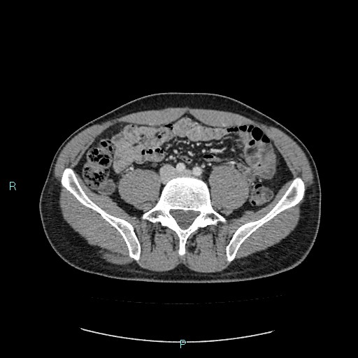 Adrenal cystic lymphangioma (Radiopaedia 83161-97534 Axial C+ portal venous phase 64).jpg