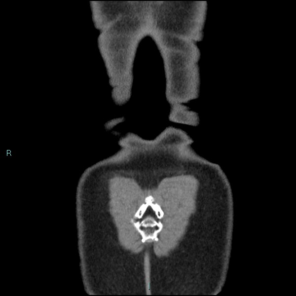 Adrenal cystic lymphangioma (Radiopaedia 83161-97534 Coronal C+ portal venous phase 77).jpg