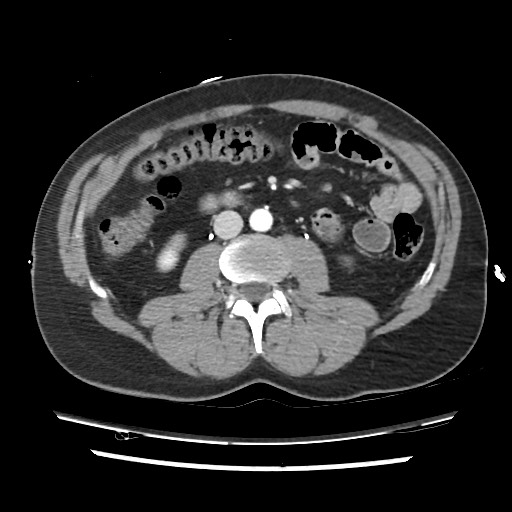 File:Adrenal gland trauma (Radiopaedia 81351-95078 Axial Dual bolus trauma C+ 80).jpg