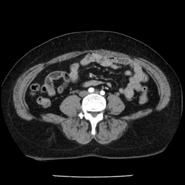 Adrenal myelolipoma (Radiopaedia 43401-46759 Axial C+ arterial phase 65).jpg