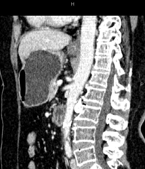 Adrenal myelolipoma (Radiopaedia 82742-96986 Sagittal renal cortical phase 60).jpg