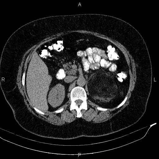 Adrenal myelolipoma (Radiopaedia 84319-99617 Axial With oral contrast 79).jpg