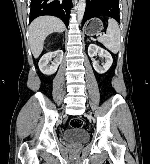 Adrenal myelolipoma (Radiopaedia 87794-104246 Coronal renal cortical phase 42).jpg