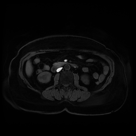 Adrenal myelolipoma - MRI (Radiopaedia 83249-97646 Axial T1 fat sat 54).jpg