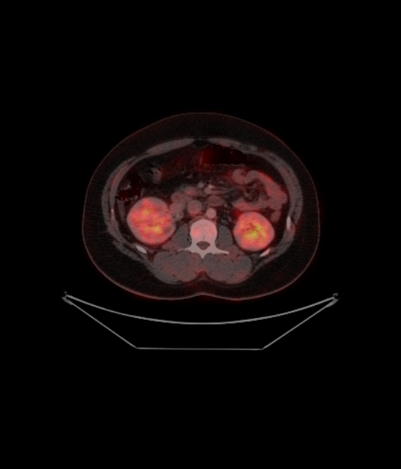 Adrenocortical carcinoma (Radiopaedia 80134-93440 ِAxial 181).jpg
