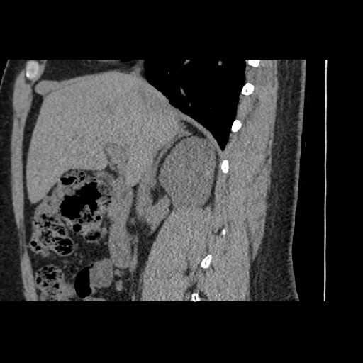 Adult polycystic kidney disease (Radiopaedia 59075-66368 Sagittal non-contrast 29).jpg