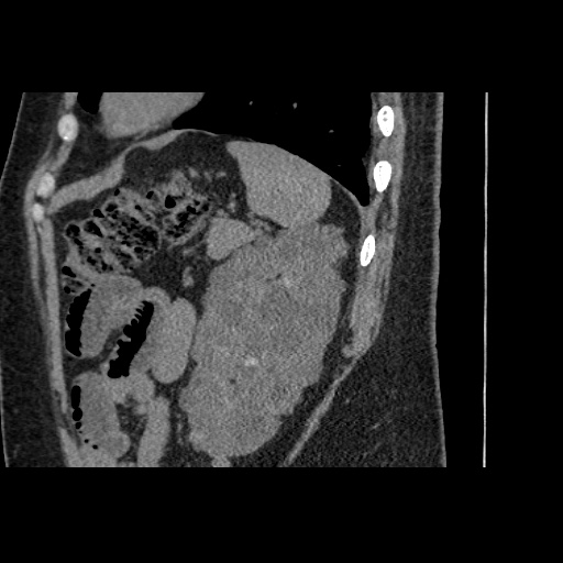 Adult polycystic kidney disease (Radiopaedia 59075-66368 Sagittal non-contrast 72).jpg